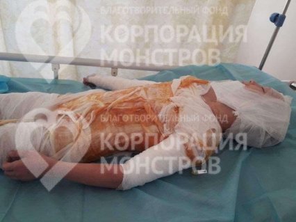 В Одессе врачи и волонтеры спасают 11-летнего мальчика с 50% ожогов тела