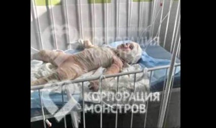Одесские врачи и волонтеры спасают 3-летнего мальчика, получившего 75% ожогов тела при пожаре